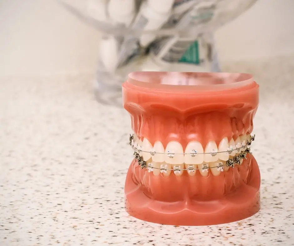 braces on mouth