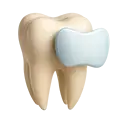 Veneers